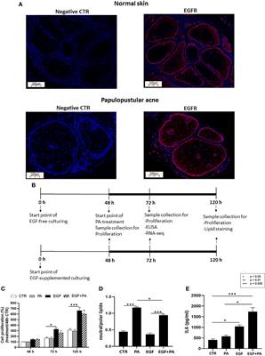 Epidermal Growth Factor Modulates Palmitic Acid-Induced Inflammatory and Lipid Signaling Pathways in SZ95 Sebocytes